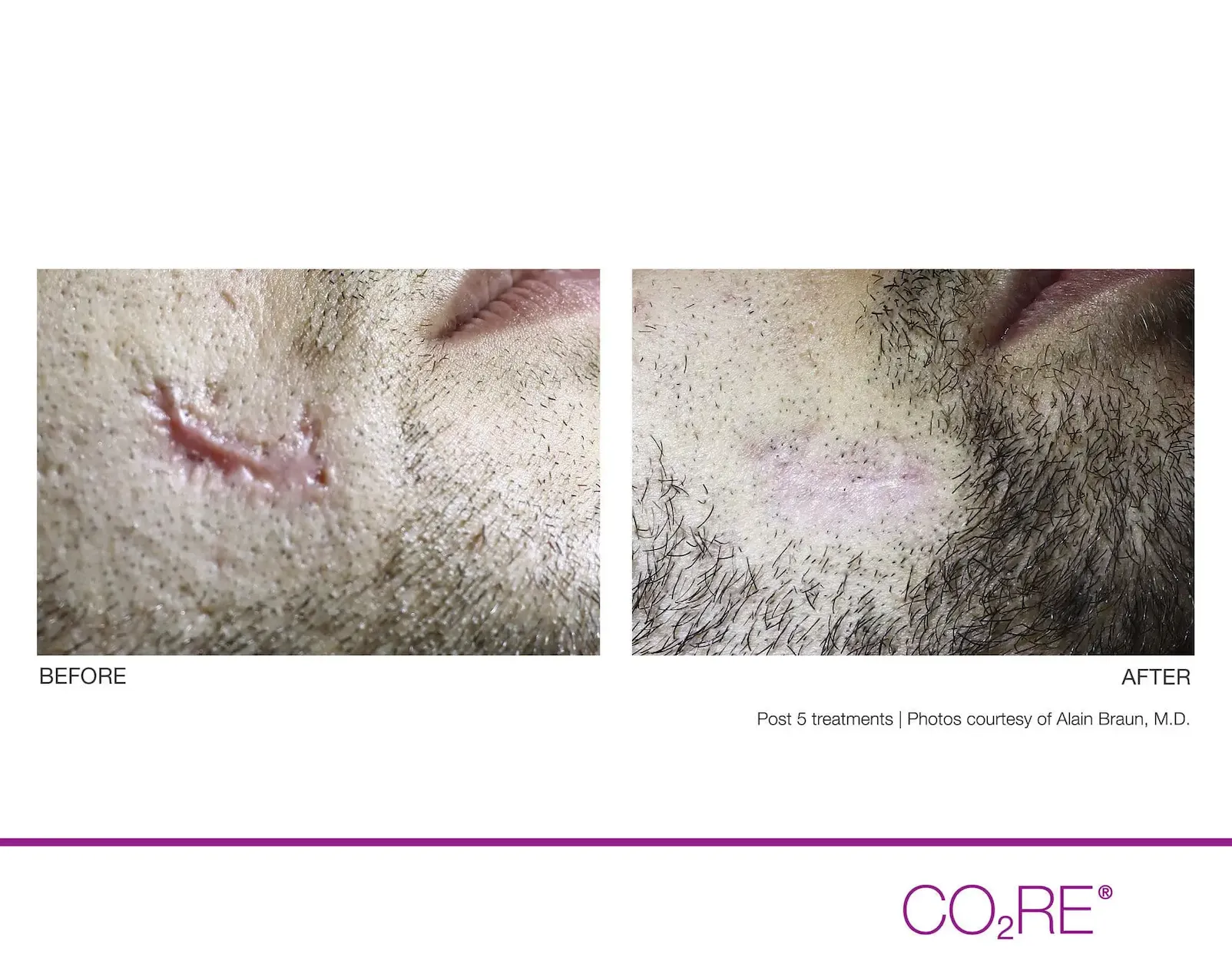 CO2 Fractional Laser Treatments