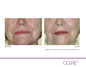 CO2 Fractional Laser Treatments