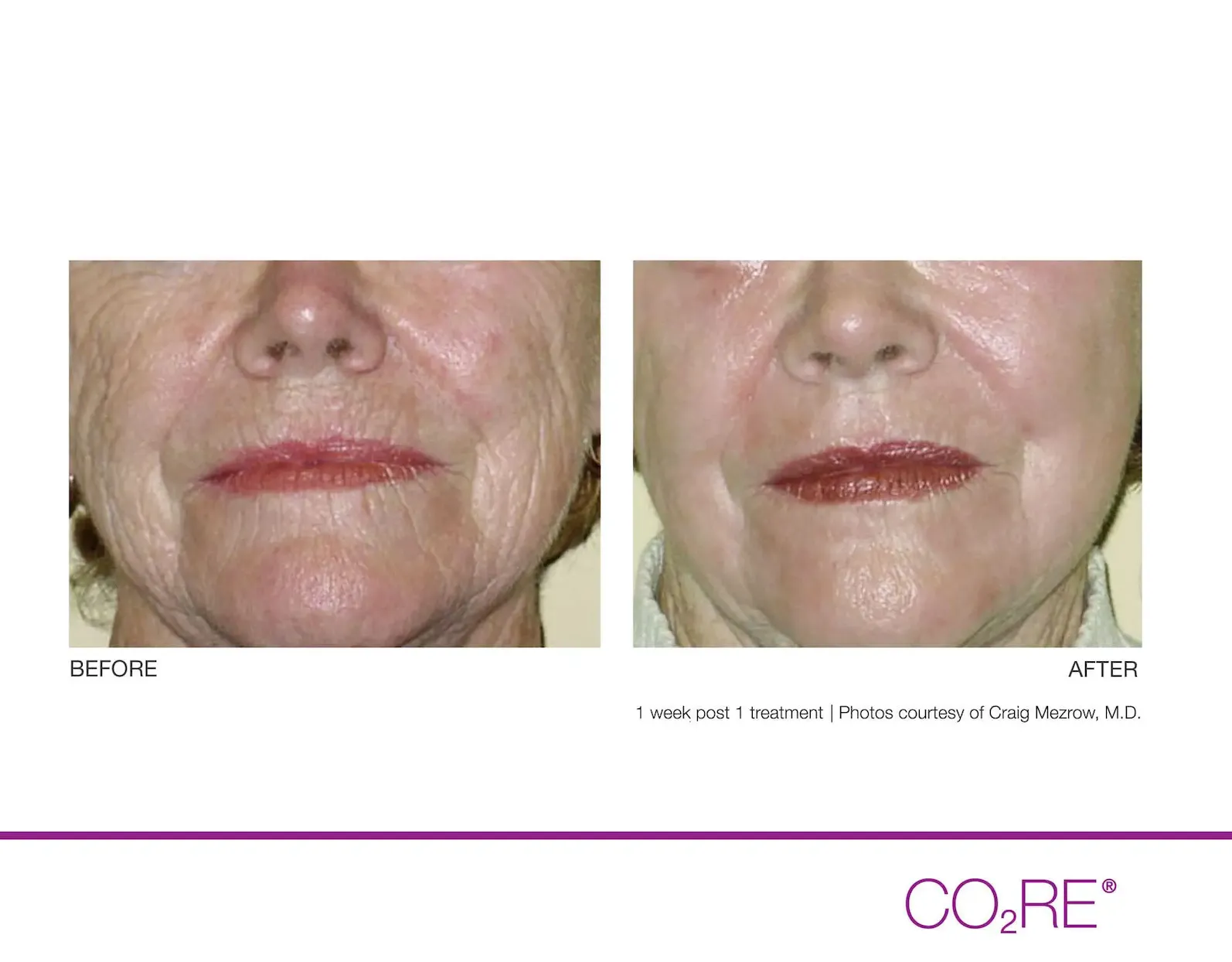 CO2 Fractional Laser Treatments