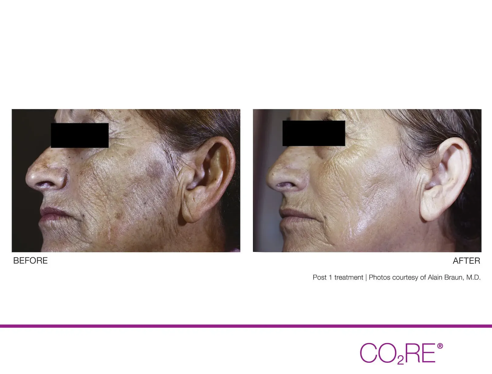 CO2 Fractional Laser Treatments